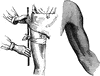 Treatment of Bleeding