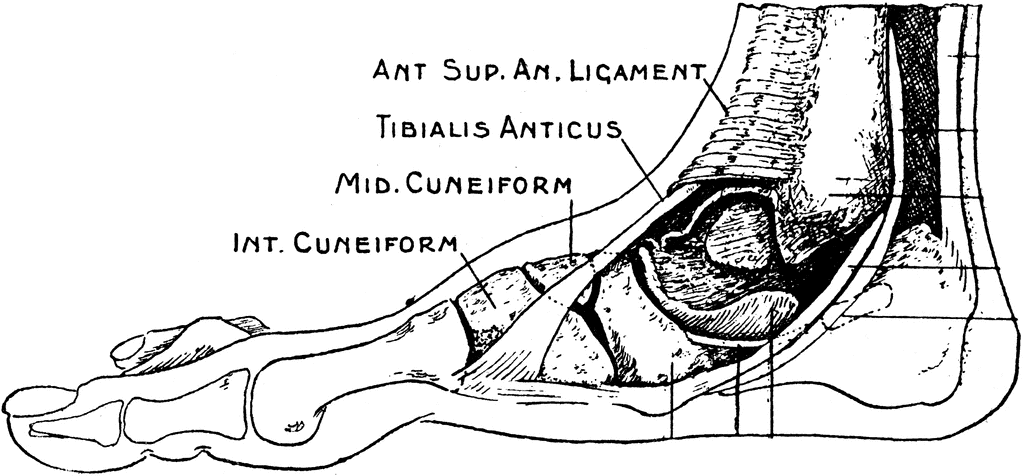 Adult Acquired Flat Feet