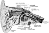 Temporal Bone Cut Open