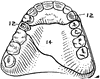 Dental Anchorage Denture