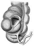 "<em>A</em>, a portion of the colon laid open to show the valve between the large and small intestine; <em>B</em>, the caecum." &mdash; Blaisedell, 1904