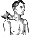 "In bleeding from wounds of the shoulder or armpit the subclavian artery may be reached by pressing the thumb deeply into the hollow behind the collar bone." &mdash; Moss, 1914