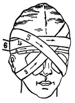 This illustration shows a method of applying a bandage to the face to cover both eyes.
