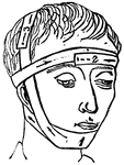 This illustration shows a method of applying a bandage to the head.