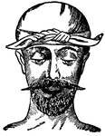This illustration shows a method of applying a bandage to the head.