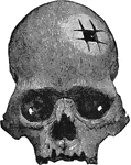 An Inca skull.