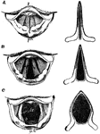 The larynx as seen by means of the laryngoscope in different conditions of the glottis. Labels: A, while singing a high note; b, in quiet breathing; C, during a deep inspiration; l, base of tongue; e, upper free edge of epiglottis; e', cushion of the epiglottis; ph, part of anterior wall of pharynx; cv, the true vocal cords; cvs, the false vocal cords; tr, the trachea with its rings; b, the two bronchi at their commencement.