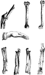 Types of broken bones.