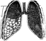 Lung infected with consumption (tuberculosis), showing the intervesicular changes).