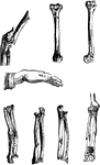 Examples of bone fractures.