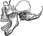 Dislocation of the lower jaw.