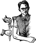 This image shows a tourniquet was improvised to compress the right brachial. Twisting with a knife or stick is easy to apply pressure but also easy to cause other damage.