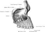The alveolar process and teeth were ground off until the antrum of highmore was well exposed; its anterior wall was removed.