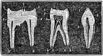 The molar teeth of a human, horse and dog. The first image to the left in a molar tooth of a horse. Labels: 1, The enamel. 2, The ivory. 3, Canals for blood vessels. The center image is a molar tooth of a human. Label: 1, The enamel. 2, The ivory. 3, The cavity containing blood vessels. 4, 5, Artery and nerve. The image on the right is a molar tooth of a dog. Labels: 1, The enamel. 2, The ivory. 3, Cavity for blood-vessels.