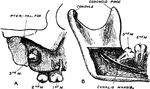 Impaction of the upper third molar in the maxilla. B, Impaction of the lower third molar in the mandible.