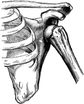 Subcoracoid dislocation of the humerus.