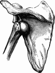 Subspinous dislocation of the humerus.