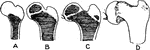 Illustrating the ossification of the upper end of the femur and the condition of coxa vara. Labels: A, at birth; B, at second year; C, at fourth year; D, from a subject of coxa vara.