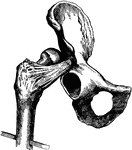 Dislocation of the hip upon the dorsum ilii.