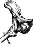 Obturator or thyroid dislocation of the hip.
