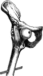 Hip dislocation upon the pubes.