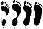 Various forms of footprints. A, normal foot with high arch; B, normal foot also with high arch; C, normal foot with low arch; D, flatfoot.