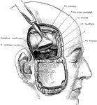 Exposure of the Gasserian ganglion and middle meningeal artery though a flap incision of the scalp and skull. The dura mater and brain are retracted upwards. The (*) points to the Foramen spinosum through which the middle meningeal artery passes as it enters the cranial cavity.