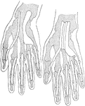 Projections of two types of flexor tendon sheaths. Note that in the hand upon the right side there is a continuation between the little finger and the ulnar bursa, and also between the thumb and radial bursa. Note also the connecting sheaths between. In the hand upon the left side the sheaths are separated not alone from their respective fingers but from each other. The type noted upon the right side is the one usually found.