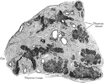 Section of thymus body of man of twenty eight, showing invasion and replacement of thymus tissue by fat.