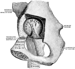 Right hip joint, from the mesal side. The bottom of the acetabulum had been chiseled away sufficiently to make the head of the femur visible.
