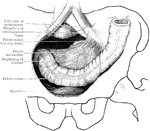 The iliac and pelvic colons, from a formalin-hardened male body, aged 30. The pelvic colon was usually long; its course is shown, as well as that of the beginning of the rectum, by dotted lines. It first ran across the upper surface of the bladder to the right pelvic wall, then recrossed the pelvis in a line posterior to is first crossing; finally it returned towards the middle line, and passed into the rectum. As a rule, after crossing to the right side of the pelvis, the pelvic colon turns backwards and inwards to reach the middle line, where it passes into the rectum.