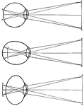 Diagrams of how an image is displayed with a normal eye (top image), myopic or nearsighted eye (middle image), and a hypermetropic or far-sighted eye. In a human, the retina "sees" an image upside down and the brain rights the image.